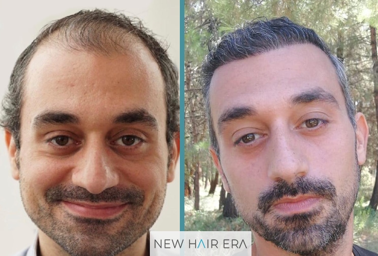 hair transplant result after 10 months,younger man